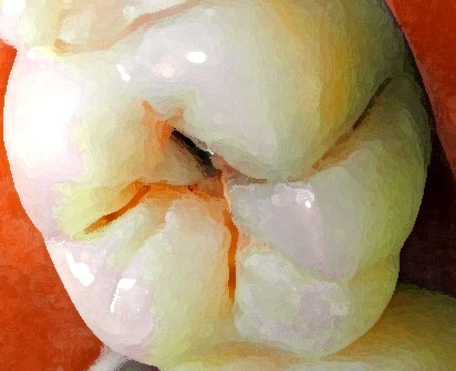 ¿Qué es una Caries Dental? ¿Qué es una Caries Dental?