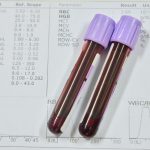 Conozca los valores normales de la hemoglobina Salud