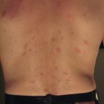 Qué se conoce como Pitiriasis versicolor o micosis Cultura y Ocio