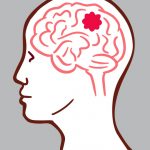 Conoce los tipos de tumores que existen Salud