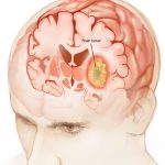 El riesgo de los tumores cerebrales Salud