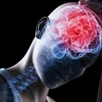 ¿Qué es una conmoción? Salud